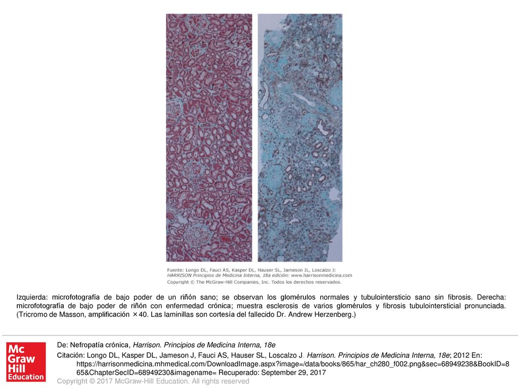 Izquierda: microfotografía de bajo poder de un riñón sano; se observan los glomérulos normales y tubulointersticio sano sin fibrosis. Derecha: microfotografía de bajo poder de riñón con enfermedad crónica; muestra esclerosis de varios glomérulos y fibrosis tubulointersticial pronunciada. (Tricromo de Masson, amplificación ×40. Las laminillas son cortesía del fallecido Dr. Andrew Herzenberg.)