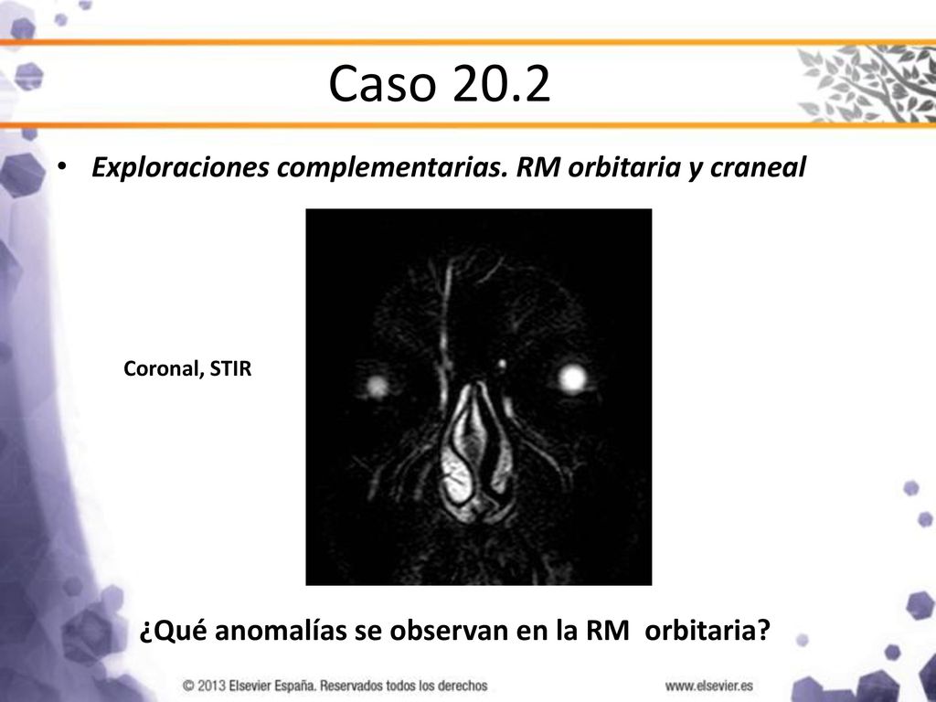 Caso 20.2 Exploraciones complementarias. RM orbitaria y craneal