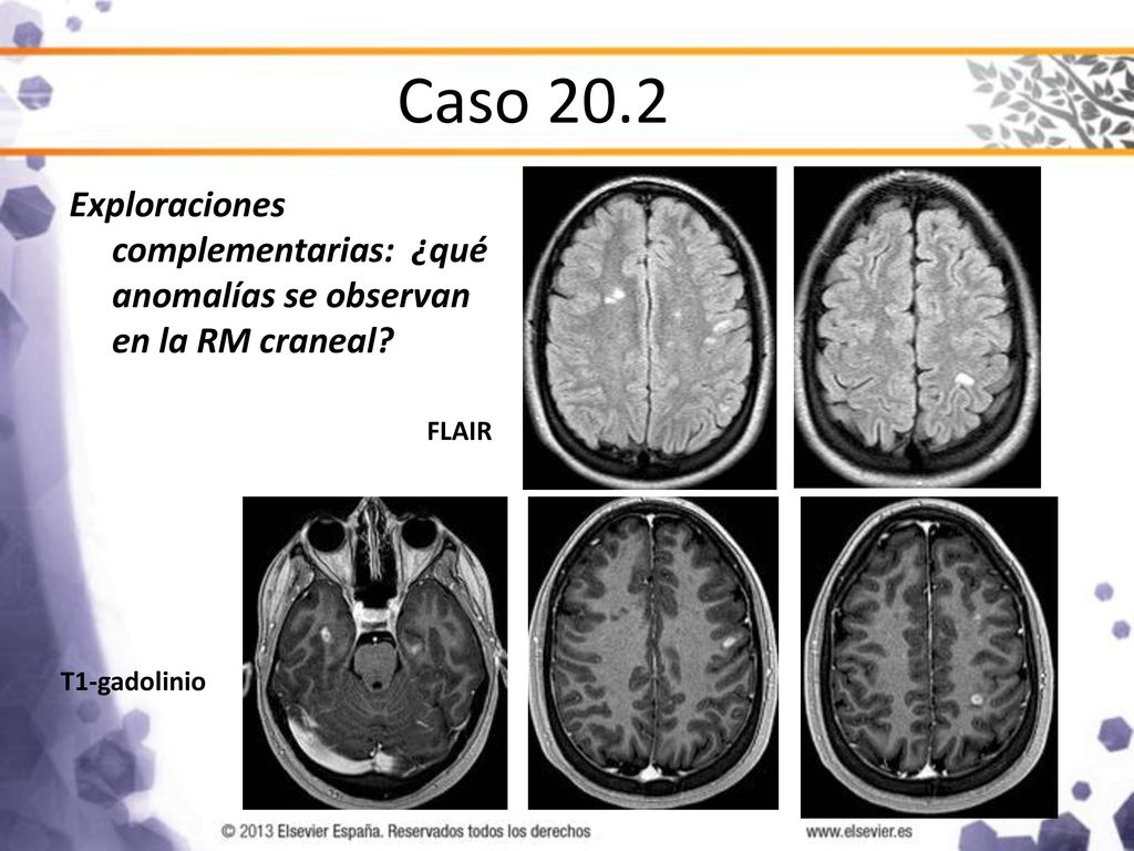 Caso 20.2 Exploraciones complementarias: ¿qué anomalías se observan en la RM craneal.
