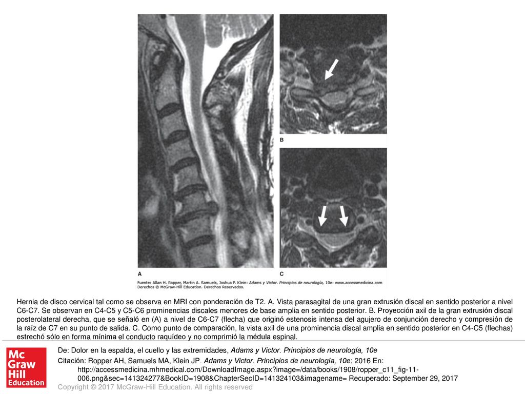 Hernia de disco cervical tal como se observa en MRI con ponderación de T2. A. Vista parasagital de una gran extrusión discal en sentido posterior a nivel C6-C7. Se observan en C4-C5 y C5-C6 prominencias discales menores de base amplia en sentido posterior. B. Proyección axil de la gran extrusión discal posterolateral derecha, que se señaló en (A) a nivel de C6-C7 (flecha) que originó estenosis intensa del agujero de conjunción derecho y compresión de la raíz de C7 en su punto de salida. C. Como punto de comparación, la vista axil de una prominencia discal amplia en sentido posterior en C4-C5 (flechas) estrechó sólo en forma mínima el conducto raquídeo y no comprimió la médula espinal.