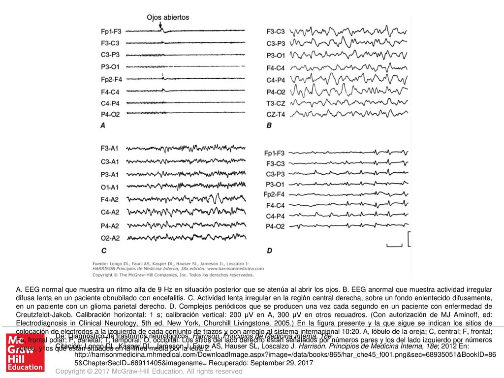A. EEG normal que muestra un ritmo alfa de 9 Hz en situación posterior que se atenúa al abrir los ojos. B. EEG anormal que muestra actividad irregular difusa lenta en un paciente obnubilado con encefalitis. C. Actividad lenta irregular en la región central derecha, sobre un fondo enlentecido difusamente, en un paciente con un glioma parietal derecho. D. Complejos periódicos que se producen una vez cada segundo en un paciente con enfermedad de Creutzfeldt-Jakob. Calibración horizontal: 1 s; calibración vertical: 200 μV en A, 300 μV en otros recuadros. (Con autorización de MJ Aminoff, ed: Electrodiagnosis in Clinical Neurology, 5th ed. New York, Churchill Livingstone, 2005.) En la figura presente y la que sigue se indican los sitios de colocación de electrodos a la izquierda de cada conjunto de trazos y con arreglo al sistema internacional 10:20. A, lóbulo de la oreja; C, central; F, frontal; Fp, frontal polar; P, parietal; T, temporal; O, occipital. Los sitios del lado derecho están señalados por números pares y los del lado izquierdo por números nones, y los que están situados en la línea media por la letra Z.