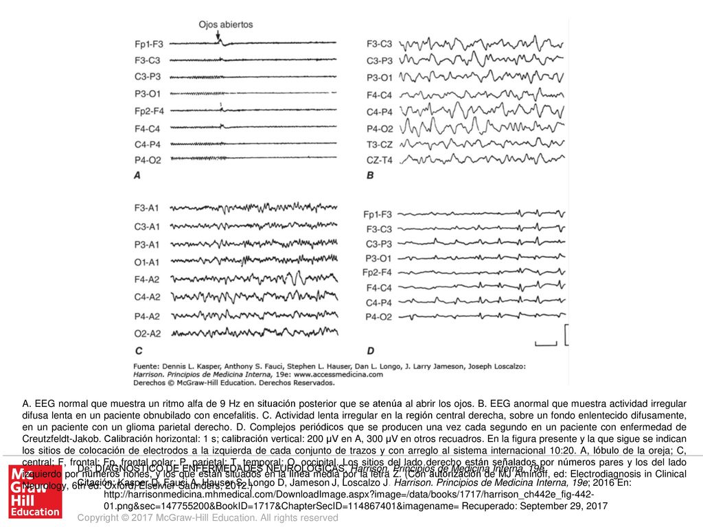 A. EEG normal que muestra un ritmo alfa de 9 Hz en situación posterior que se atenúa al abrir los ojos. B. EEG anormal que muestra actividad irregular difusa lenta en un paciente obnubilado con encefalitis. C. Actividad lenta irregular en la región central derecha, sobre un fondo enlentecido difusamente, en un paciente con un glioma parietal derecho. D. Complejos periódicos que se producen una vez cada segundo en un paciente con enfermedad de Creutzfeldt-Jakob. Calibración horizontal: 1 s; calibración vertical: 200 μV en A, 300 μV en otros recuadros. En la figura presente y la que sigue se indican los sitios de colocación de electrodos a la izquierda de cada conjunto de trazos y con arreglo al sistema internacional 10:20. A, lóbulo de la oreja; C, central; F, frontal; Fp, frontal polar; P, parietal; T, temporal; O, occipital. Los sitios del lado derecho están señalados por números pares y los del lado izquierdo por números nones, y los que están situados en la línea media por la letra Z. (Con autorización de MJ Aminoff, ed: Electrodiagnosis in Clinical Neurology, 6th ed. Oxford, Elselvier Saunders, 2012.)