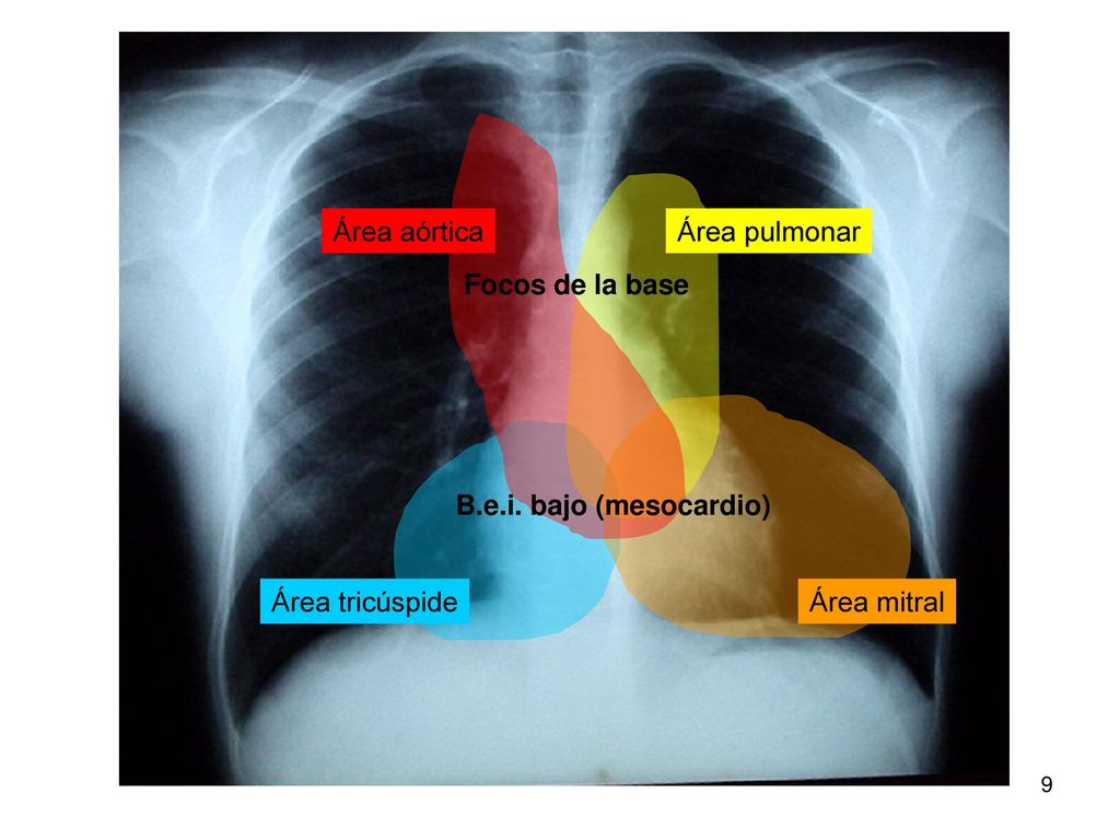 Área aórtica Área pulmonar Focos de la base B.e.i. bajo (mesocardio) Área tricúspide Área mitral
