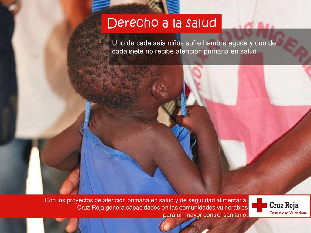 Derecho a la salud Uno de cada seis niños sufre hambre aguda y uno de