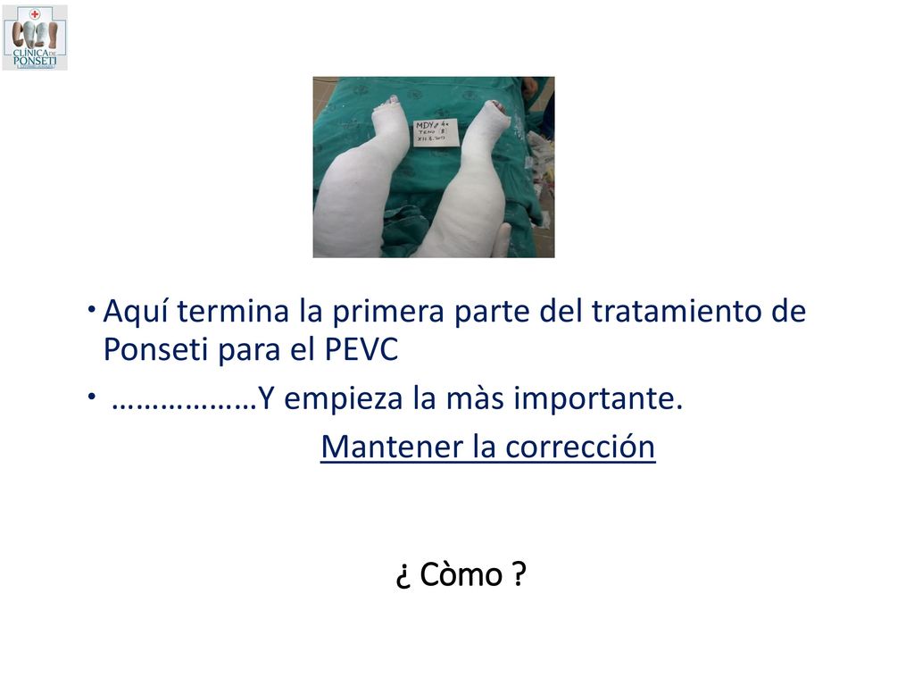 Aquí termina la primera parte del tratamiento de Ponseti para el PEVC