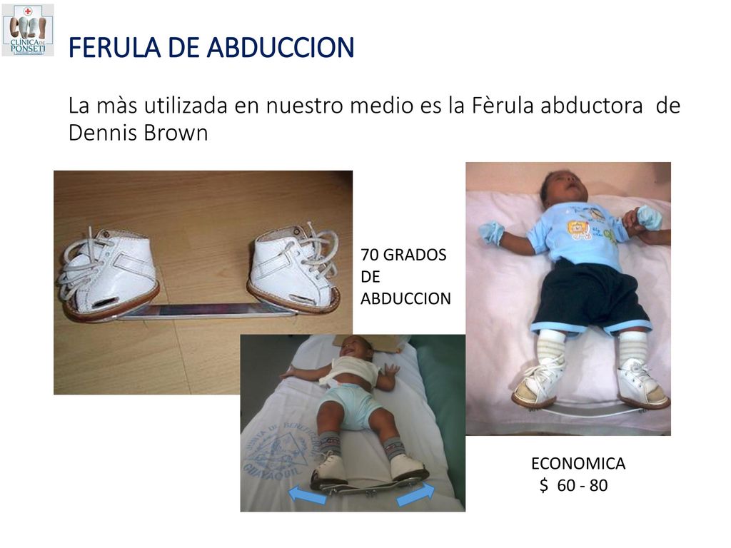 FERULA DE ABDUCCION La màs utilizada en nuestro medio es la Fèrula abductora de Dennis Brown
