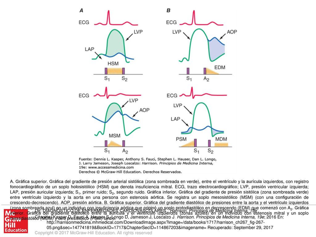 A. Gráfica superior. Gráfica del gradiente de presión arterial sistólica (zona sombreada en verde), entre el ventrículo y la aurícula izquierdos, con registro fonocardiográfico de un soplo holosistólico (HSM) que denota insuficiencia mitral. ECG, trazo electrocardiográfico; LVP, presión ventricular izquierda; LAP, presión auricular izquierda; S1, primer ruido; S2, segundo ruido. Gráfica inferior. Gráfica del gradiente de presión sistólica (zona sombreada verde) entre ventrículo izquierdo y la aorta en una persona con estenosis aórtica. Se registra un soplo mesosistólico (MSM) (con una configuración de crescendo-decrescendo). AOP, presión aórtica. B. Gráfica superior. Gráfica del gradiente diastólico de presiones entre la aorta y el ventrículo izquierdos (zona sombreada azul) en un individuo con insuficiencia aórtica que originó un soplo protodiastólico en decrescendo (EDM) que comenzó con A2. Gráfica inferior. Gráfica del gradiente diastólico entre la aurícula y el ventrículo izquierdos (zonas azules) en un individuo con estenosis mitral y un soplo mesodiastólico (MDM) y otro presistólico (PSM) tardío.