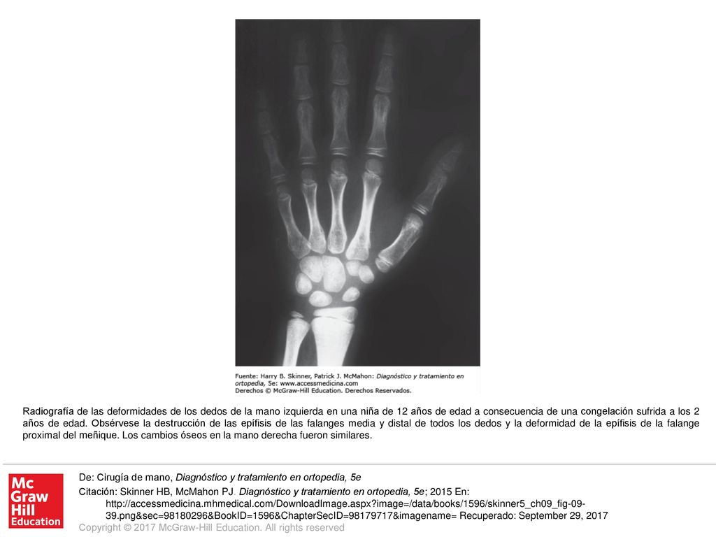 Radiografía de las deformidades de los dedos de la mano izquierda en una niña de 12 años de edad a consecuencia de una congelación sufrida a los 2 años de edad. Obsérvese la destrucción de las epífisis de las falanges media y distal de todos los dedos y la deformidad de la epífisis de la falange proximal del meñique. Los cambios óseos en la mano derecha fueron similares.