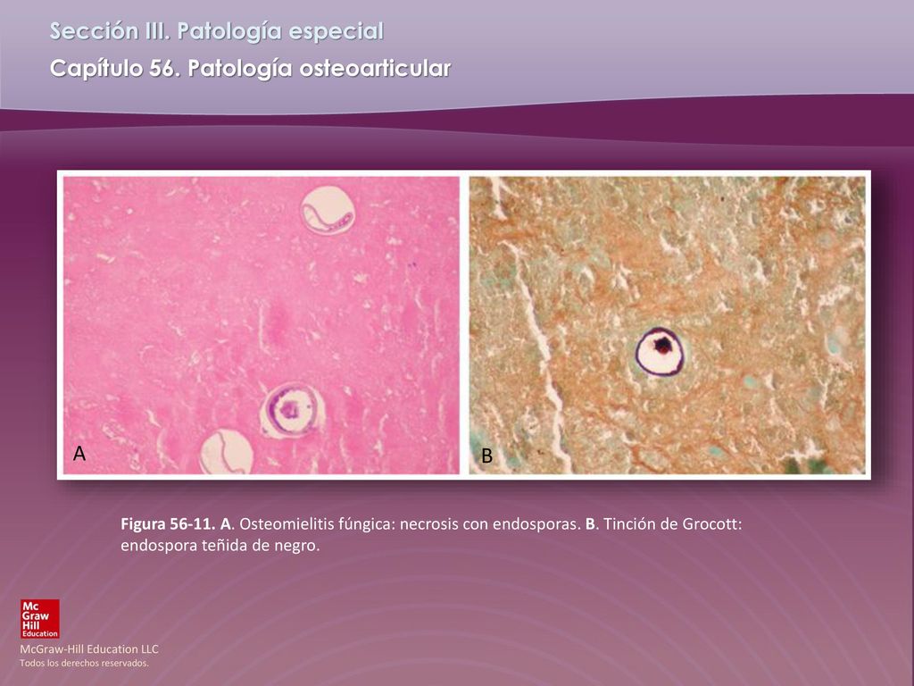A B. Figura A. Osteomielitis fúngica: necrosis con endosporas.