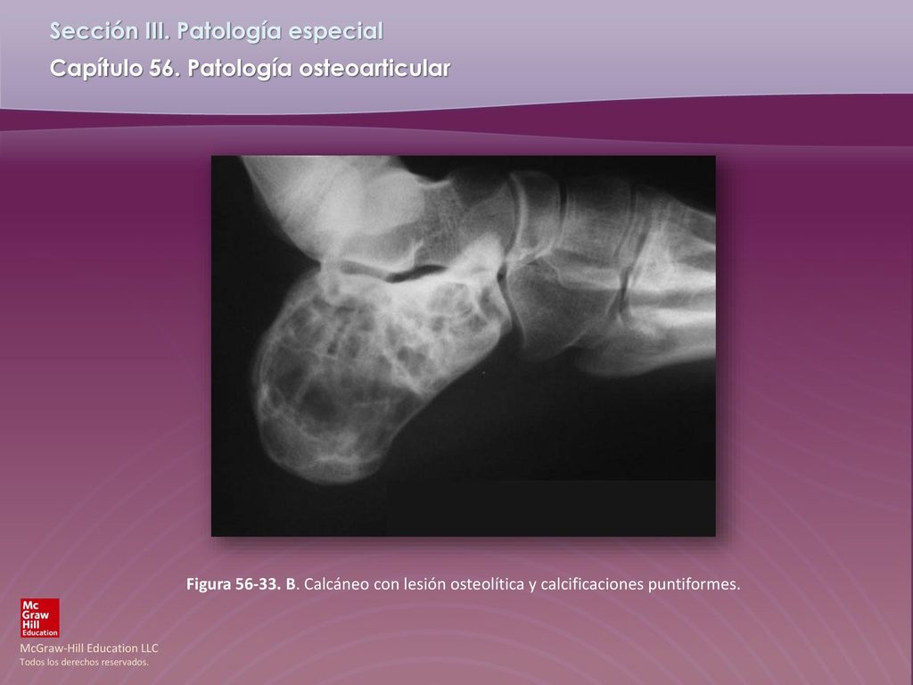 Figura B. Calcáneo con lesión osteolítica y calcificaciones puntiformes.