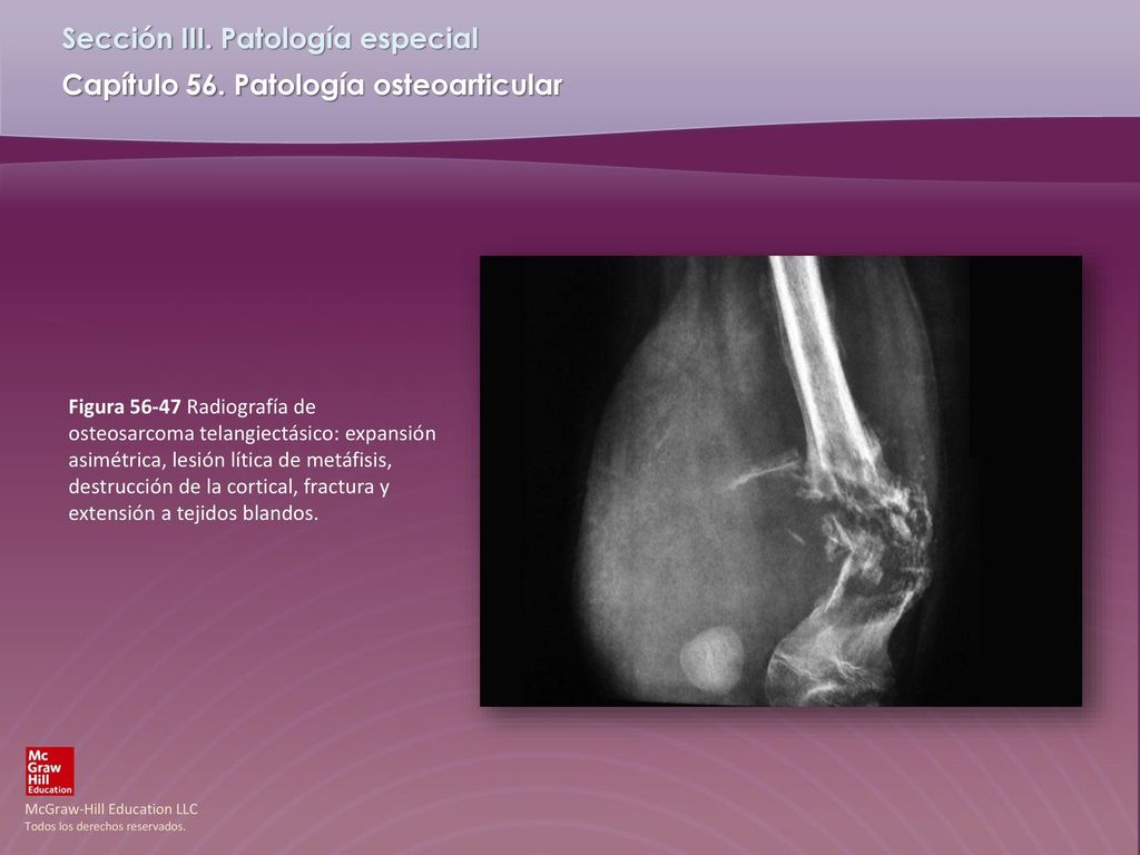Figura Radiografía de osteosarcoma telangiectásico: expansión asimétrica, lesión lítica de metáfisis, destrucción de la cortical, fractura y extensión a tejidos blandos.