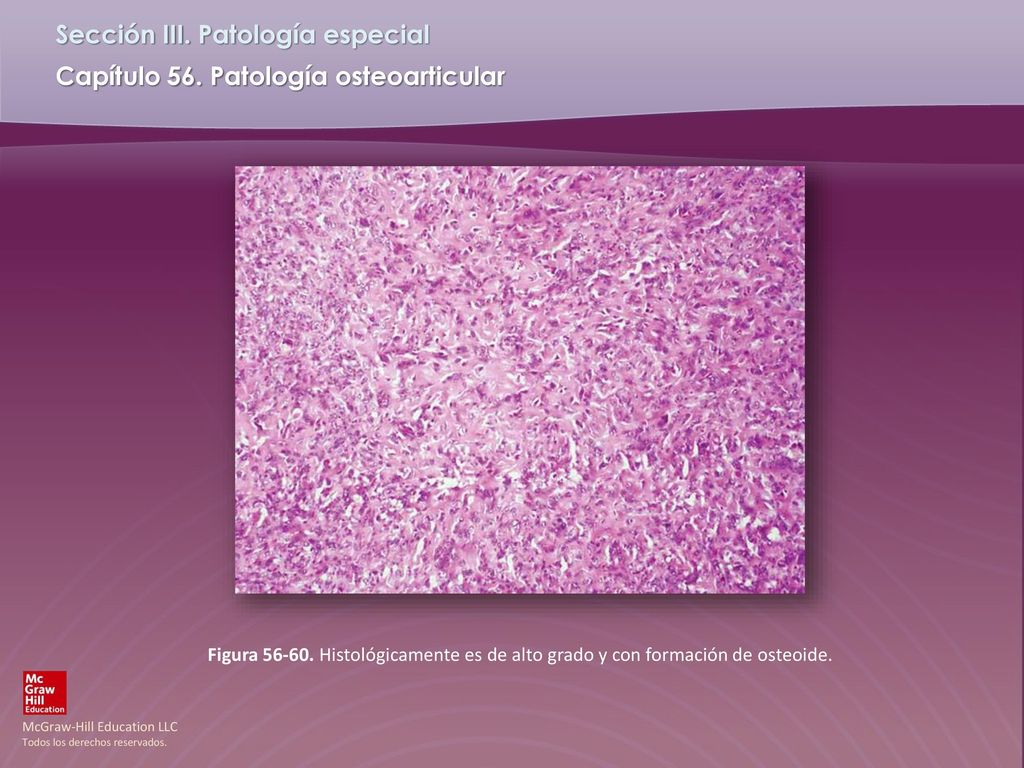 Figura Histológicamente es de alto grado y con formación de osteoide.