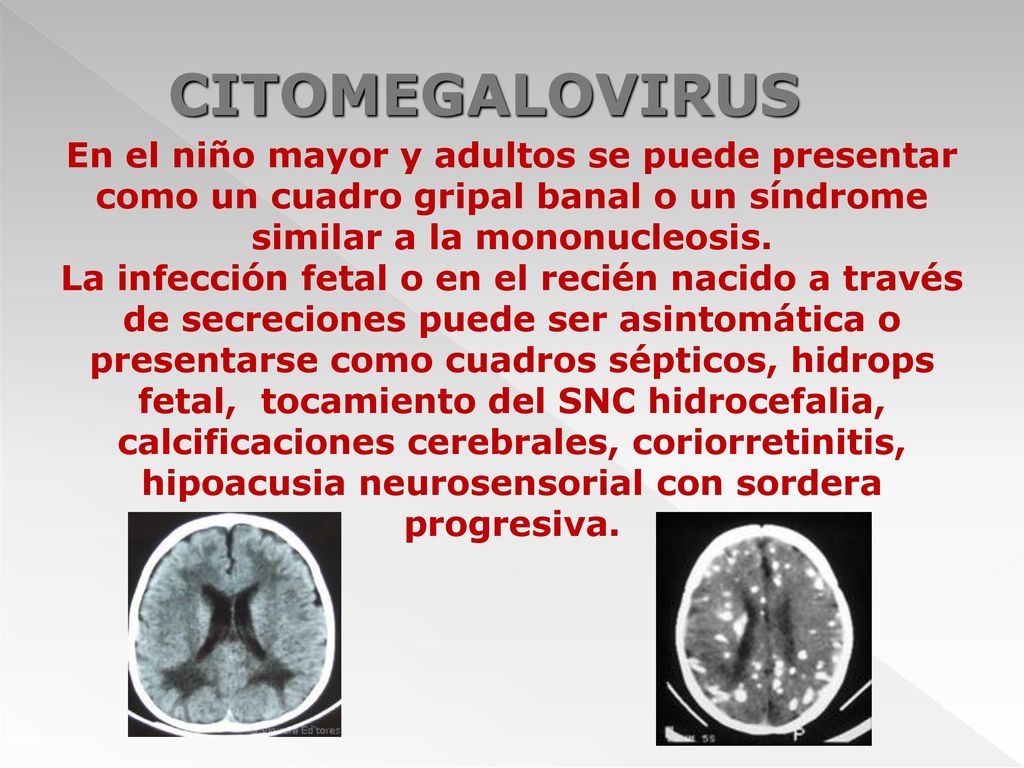CITOMEGALOVIRUS En el niño mayor y adultos se puede presentar como un cuadro gripal banal o un síndrome similar a la mononucleosis.