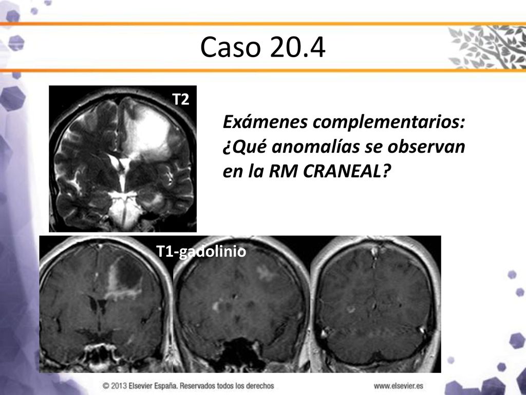 Caso 20.4 T2 T1-gadolinio Exámenes complementarios: ¿Qué anomalías se observan en la RM CRANEAL