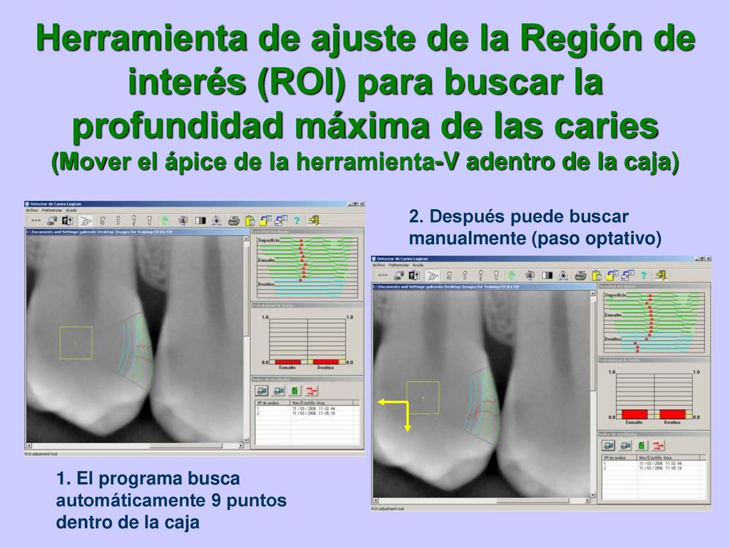 Herramienta de ajuste de la Región de interés (ROI) para buscar la profundidad máxima de las caries (Mover el ápice de la herramienta-V adentro de la caja)