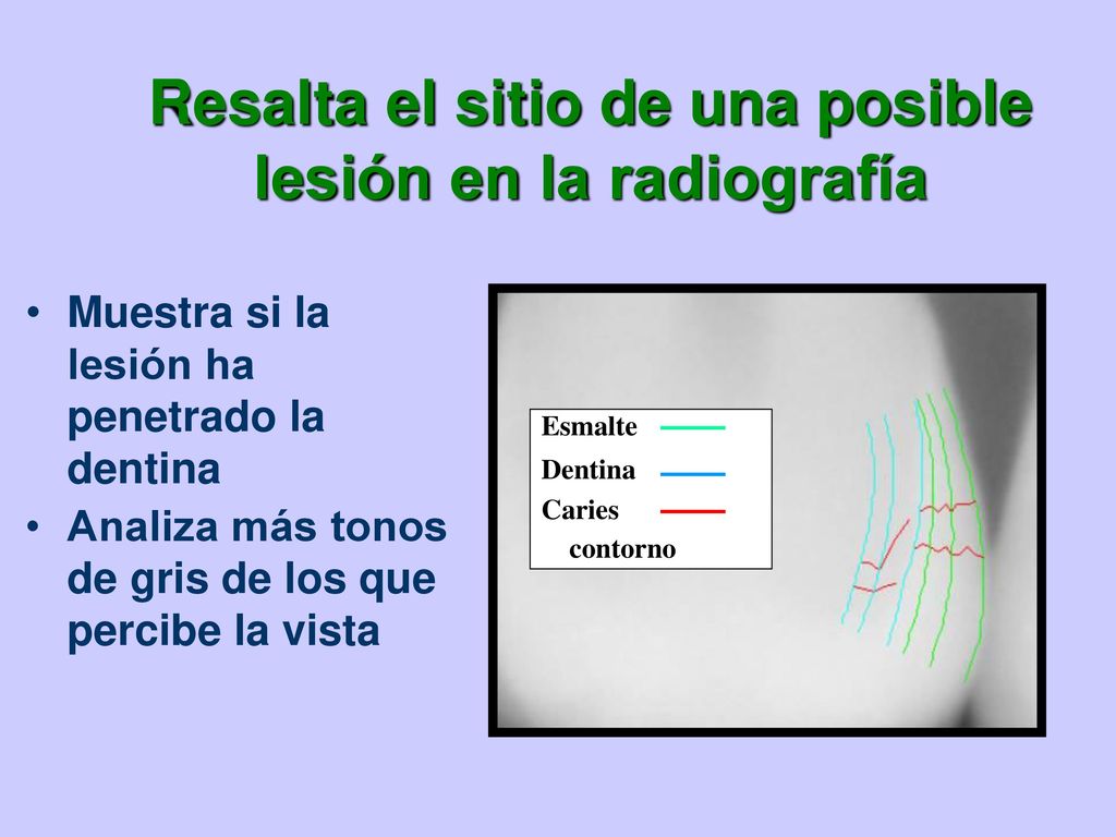 Resalta el sitio de una posible lesión en la radiografía