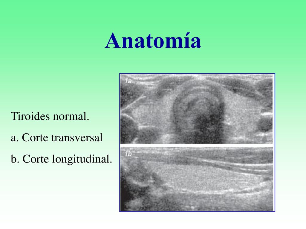 Anatomía Tiroides normal. a. Corte transversal b. Corte longitudinal.