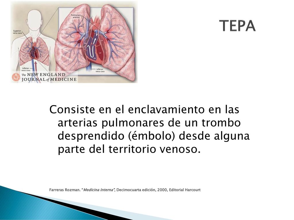 TEPA Consiste en el enclavamiento en las arterias pulmonares de un trombo desprendido (émbolo) desde alguna parte del territorio venoso.