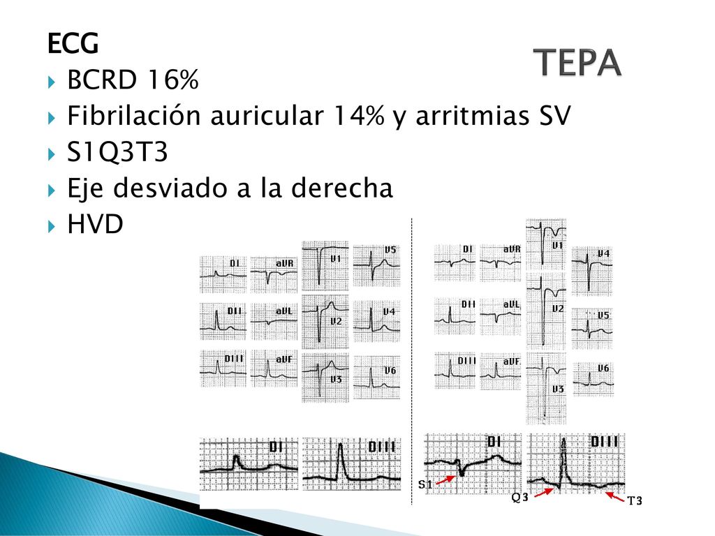 TEPA ECG BCRD 16% Fibrilación auricular 14% y arritmias SV S1Q3T3