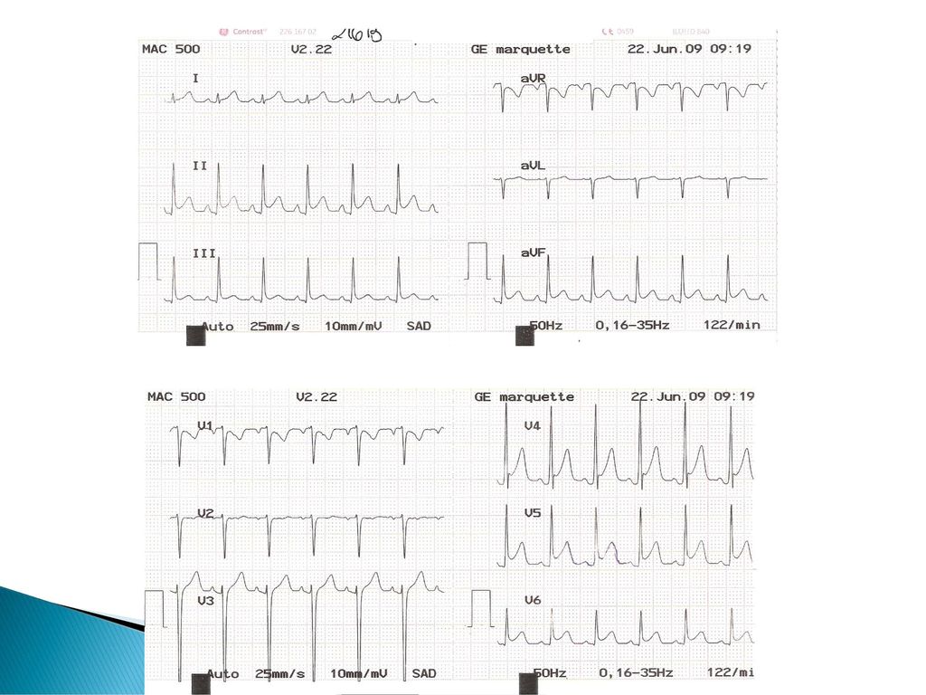 ECG: ¿Cuándo se normaliza el ECG en la pericarditis en la infancia