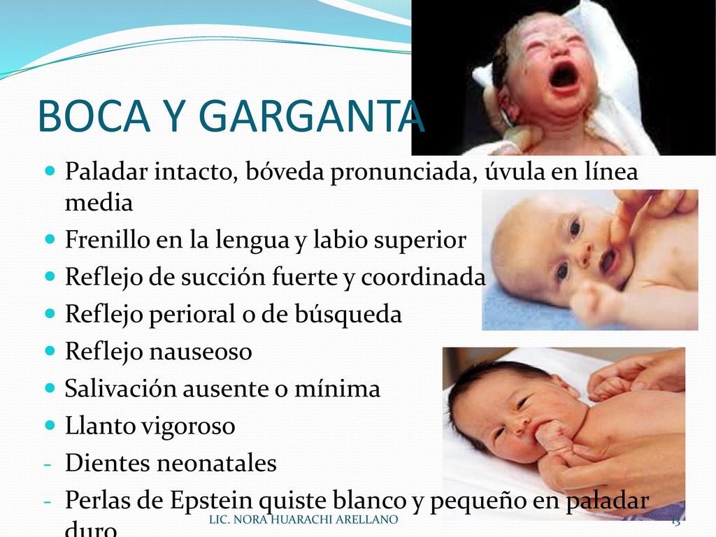 BOCA Y GARGANTA Paladar intacto, bóveda pronunciada, úvula en línea media. Frenillo en la lengua y labio superior.