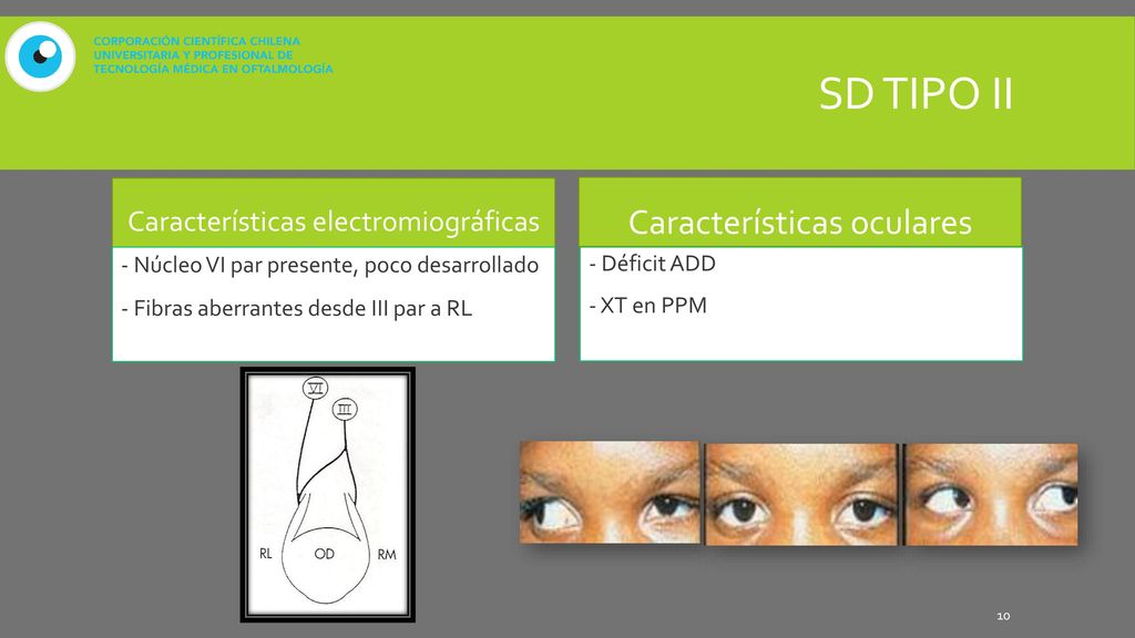 SD tipo II Características oculares Características electromiográficas