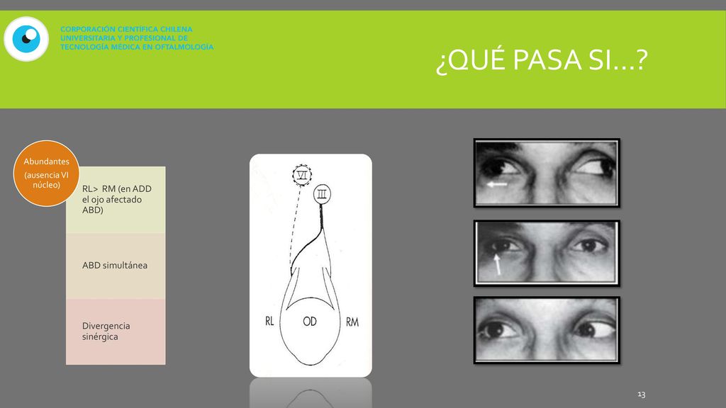 ¿Qué pasa si… RL> RM (en ADD el ojo afectado ABD) ABD simultánea