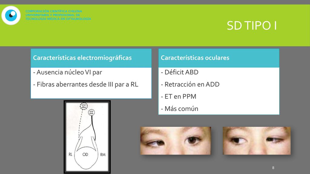 SD tipo I Características electromiográficas. Características oculares. - Ausencia núcleo VI par - Fibras aberrantes desde III par a RL