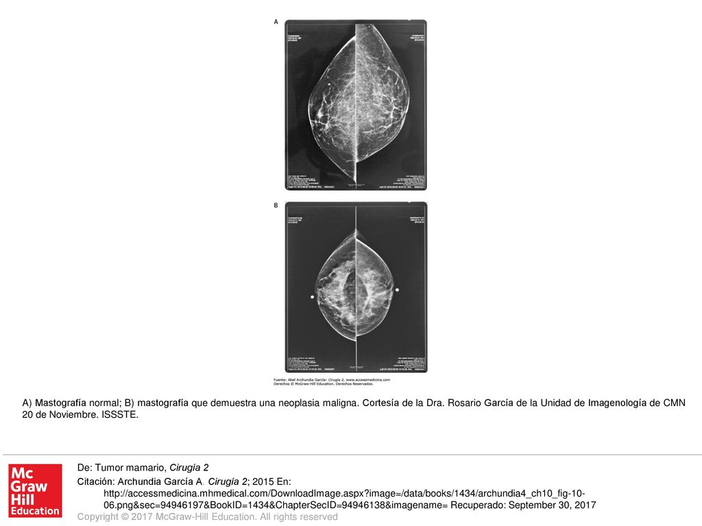 A) Mastografía normal; B) mastografía que demuestra una neoplasia maligna. Cortesía de la Dra. Rosario García de la Unidad de Imagenología de CMN 20 de Noviembre. ISSSTE.