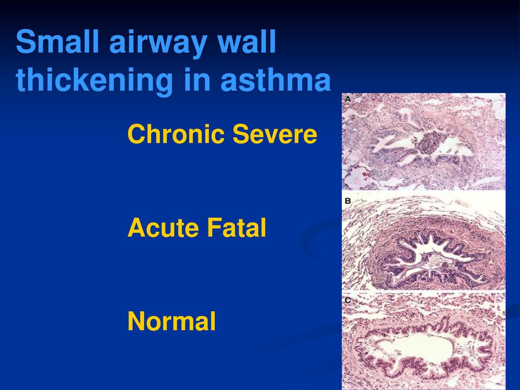 Small airway wall thickening in asthma Chronic Severe Acute Fatal