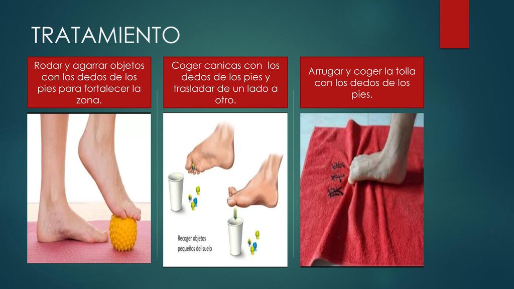 TRATAMIENTO Rodar y agarrar objetos con los dedos de los pies para fortalecer la zona.