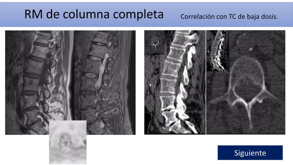 RM de columna completa Correlación con TC de baja dosis. Siguiente