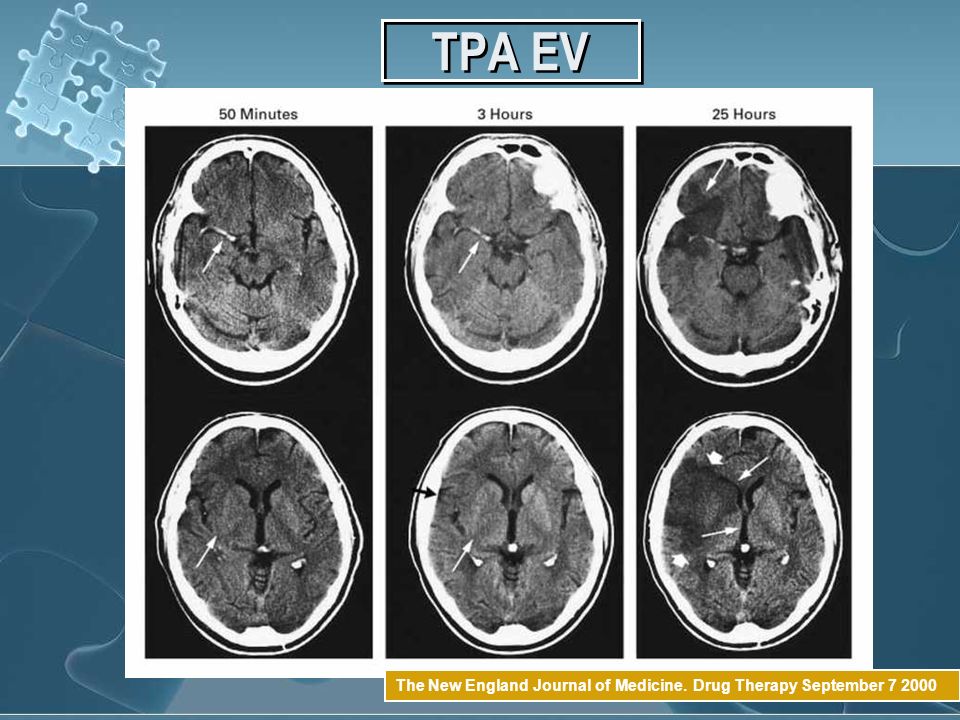 TPA EV The New England Journal of Medicine. Drug Therapy September
