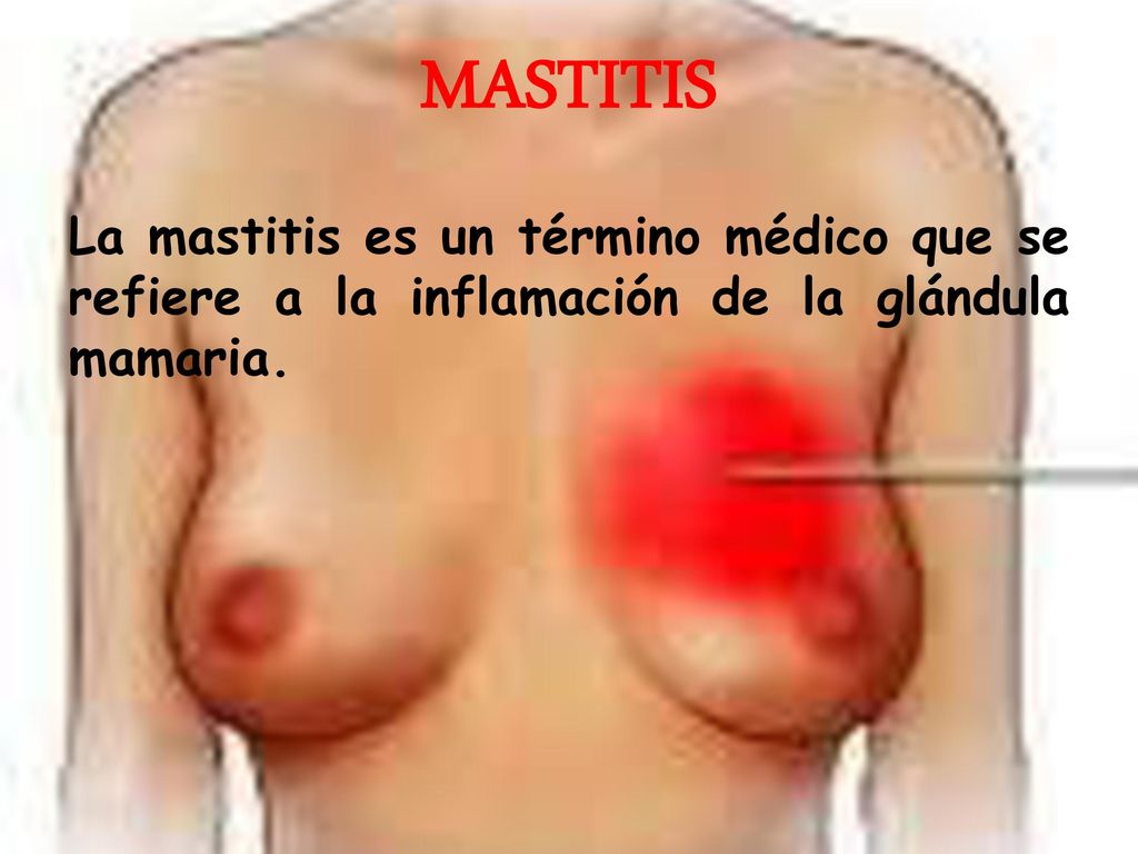 MASTITIS La mastitis es un término médico que se refiere a la inflamación de la glándula mamaria.