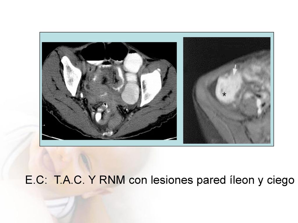 E.C: T.A.C. Y RNM con lesiones pared íleon y ciego