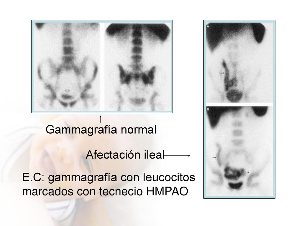 Afectación ileal Gammagrafía normal E.C: gammagrafía con leucocitos marcados con tecnecio HMPAO