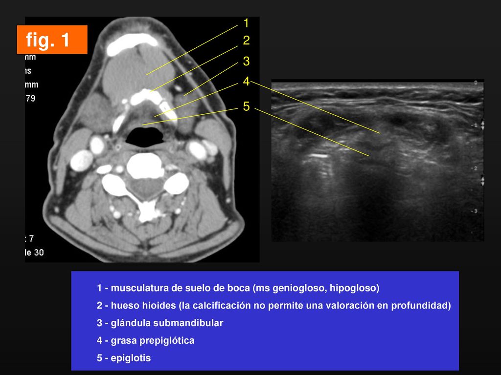 1 fig musculatura de suelo de boca (ms geniogloso, hipogloso)