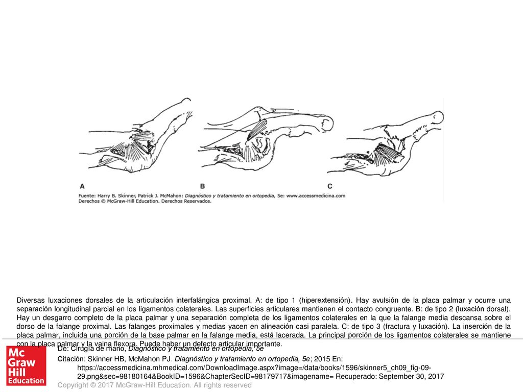 Diversas luxaciones dorsales de la articulación interfalángica proximal. A: de tipo 1 (hiperextensión). Hay avulsión de la placa palmar y ocurre una separación longitudinal parcial en los ligamentos colaterales. Las superficies articulares mantienen el contacto congruente. B: de tipo 2 (luxación dorsal). Hay un desgarro completo de la placa palmar y una separación completa de los ligamentos colaterales en la que la falange media descansa sobre el dorso de la falange proximal. Las falanges proximales y medias yacen en alineación casi paralela. C: de tipo 3 (fractura y luxación). La inserción de la placa palmar, incluida una porción de la base palmar en la falange media, está lacerada. La principal porción de los ligamentos colaterales se mantiene con la placa palmar y la vaina flexora. Puede haber un defecto articular importante.
