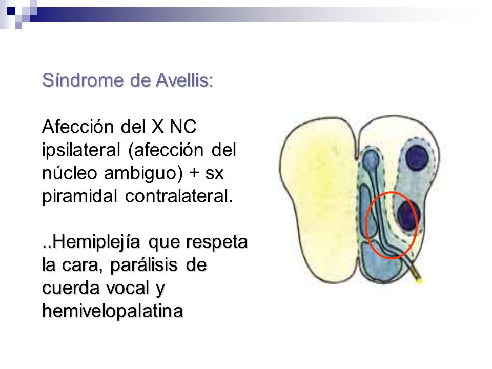 Síndrome de Avellis: Afección del X NC ipsilateral (afección del núcleo ambiguo) + sx piramidal contralateral.