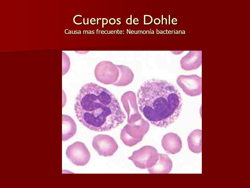 Cuerpos de Dohle Causa mas frecuente: Neumonía bacteriana