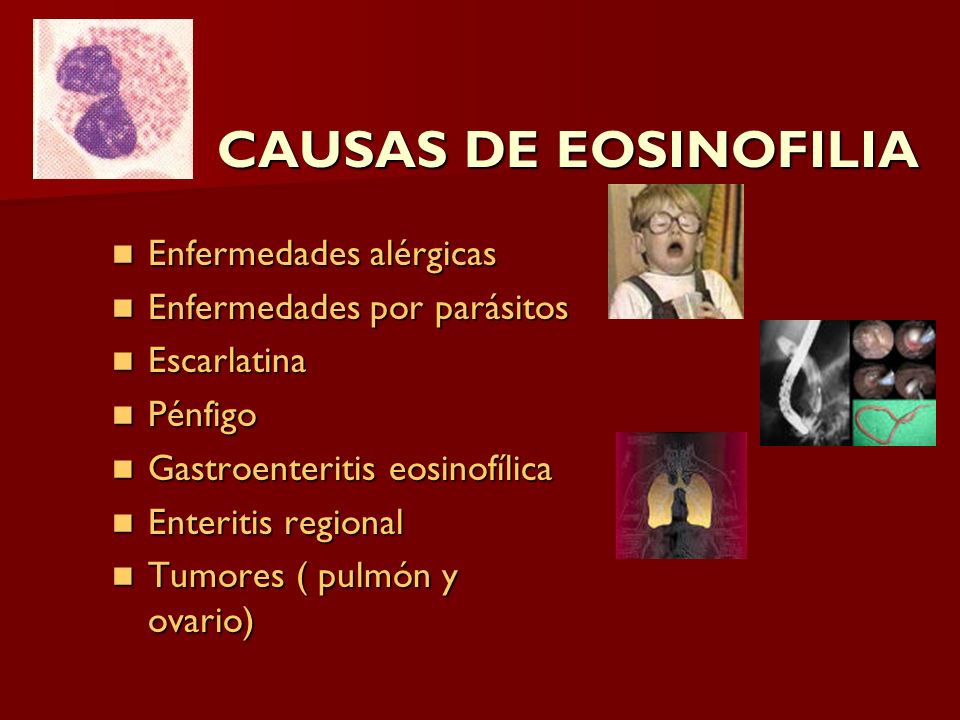 CAUSAS DE EOSINOFILIA Enfermedades alérgicas