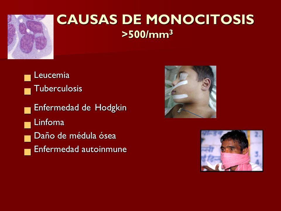 CAUSAS DE MONOCITOSIS >500/mm3