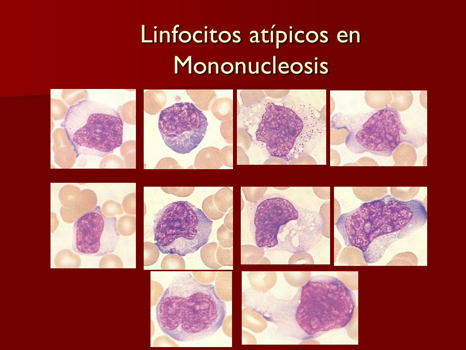 Linfocitos atípicos en Mononucleosis