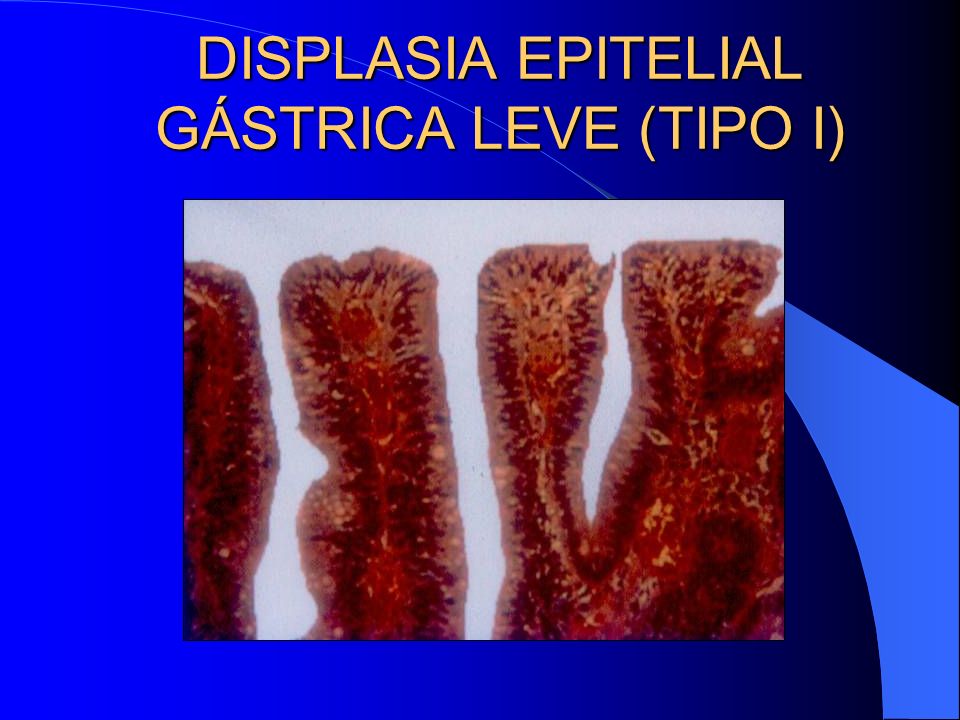 DISPLASIA EPITELIAL GÁSTRICA LEVE (TIPO I)
