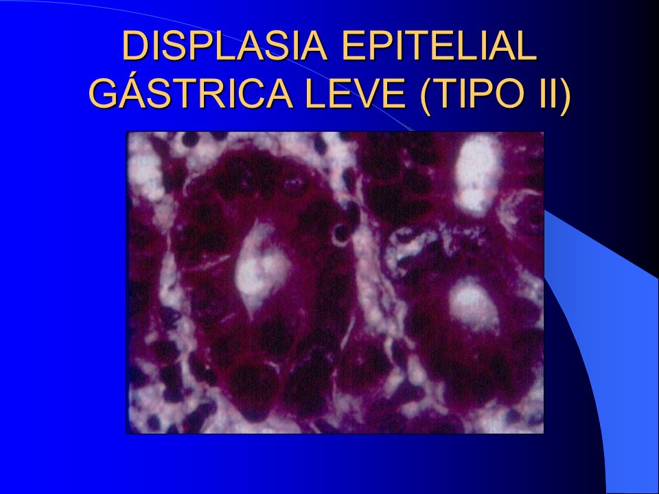 DISPLASIA EPITELIAL GÁSTRICA LEVE (TIPO II)