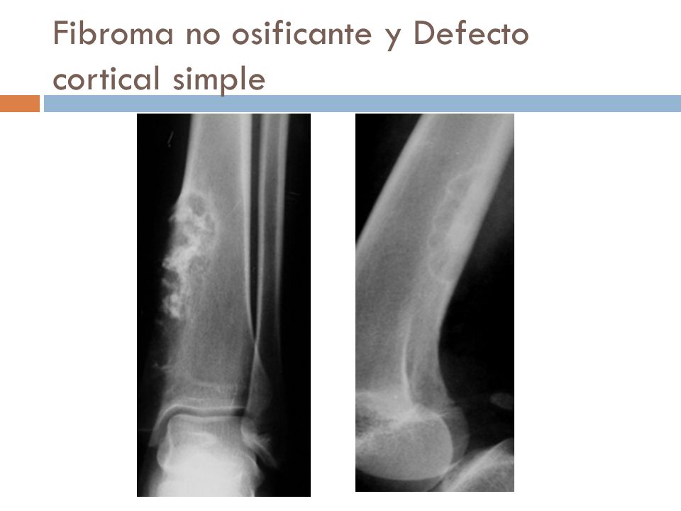 Fibroma no osificante y Defecto cortical simple