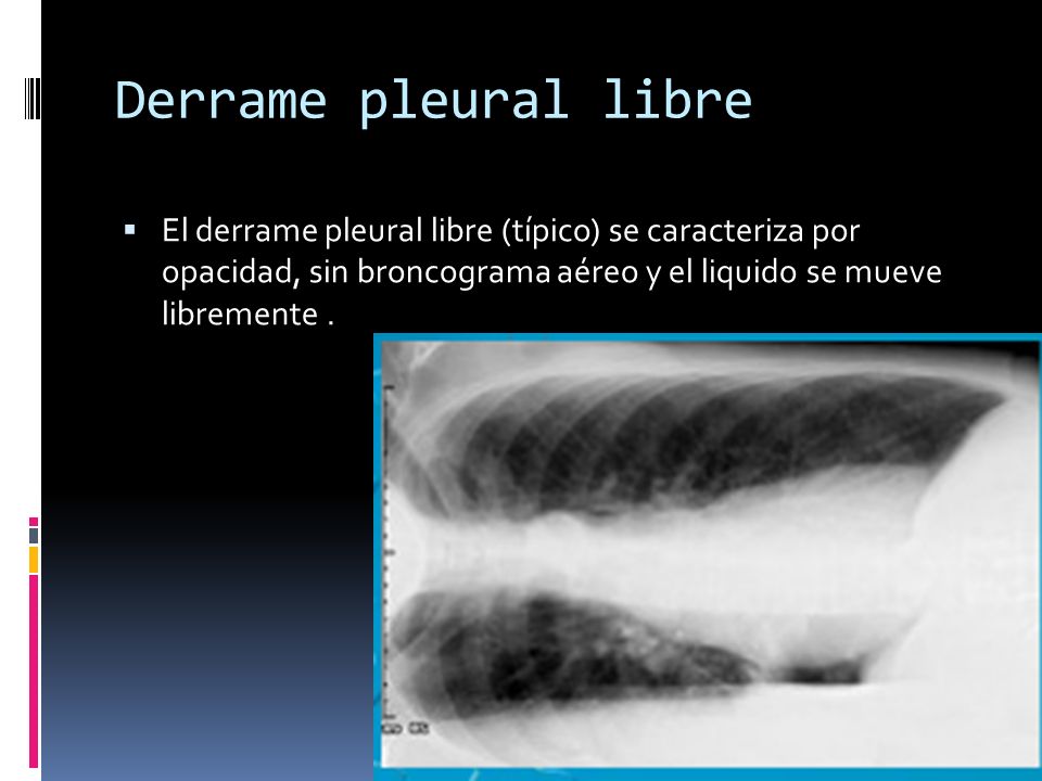 Derrame pleural libre El derrame pleural libre (típico) se caracteriza por opacidad, sin broncograma aéreo y el liquido se mueve libremente .