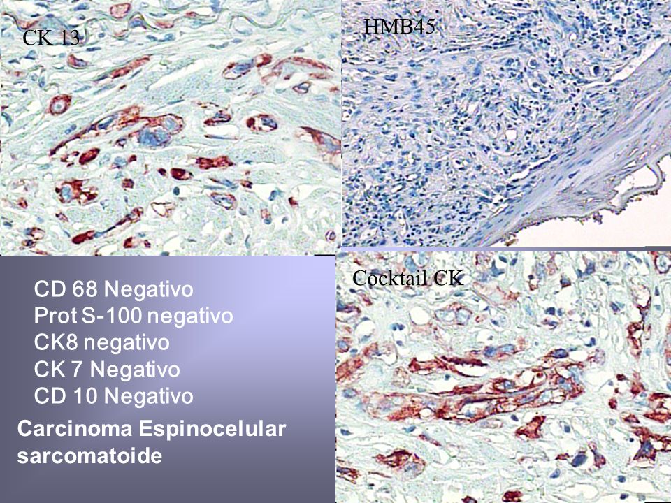 HMB45 CK 13. Cocktail CK. CD 68 Negativo. Prot S-100 negativo. CK8 negativo. CK 7 Negativo. CD 10 Negativo.