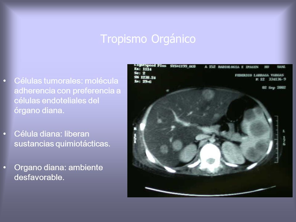 Tropismo Orgánico Células tumorales: molécula adherencia con preferencia a células endoteliales del órgano diana.