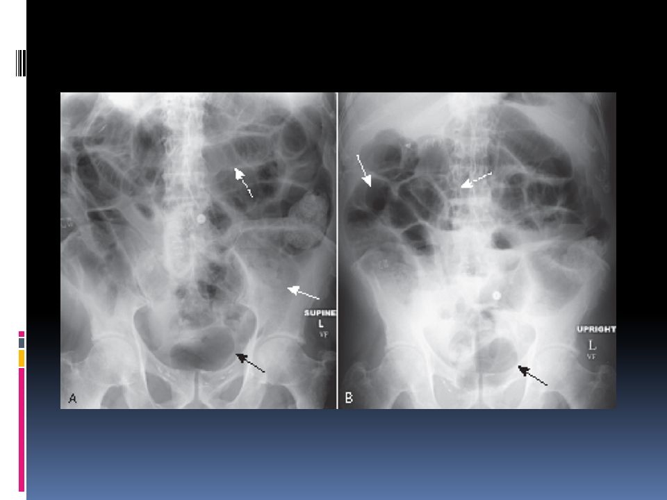 Generalized adynamic ileus, supine (A) and upright abdomen (B)